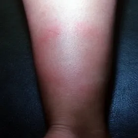 Ból łydki z boku rumień guzowaty