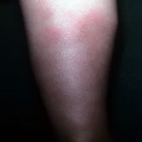 Ból łydki z tyłu rumień guzowaty