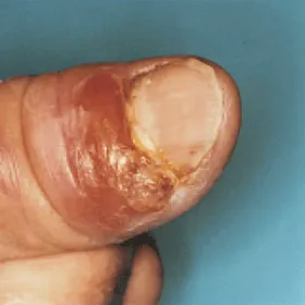 Ból palca po ukłuciu kolcem róży sporotrychoza 