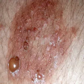 Bąble pokrzywkowe choroba Duhringa