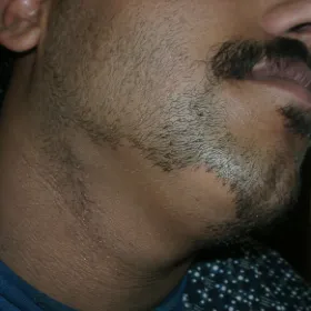 BAA – alopecia areata of the beard area