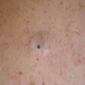 Bardzo głębokie zaskórniki