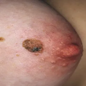 Brodawka łojotokowa na piersi