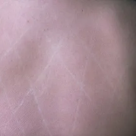 Biała pokrzywka na skórze