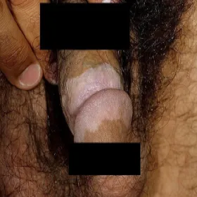 Białe plamy miejsc intymnych u meżczyzn