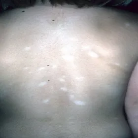 Białe plamy na plecach