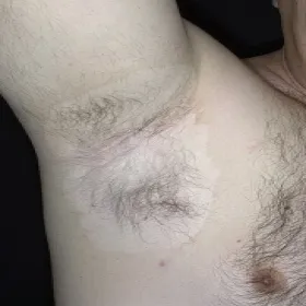 Białe plamy na skórze pod pachą