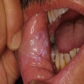 Biały nalot na poliku wewnątrz