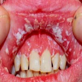 Biały nalot w jamie ustnej