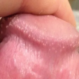 Biale krostki na zoledziu grudki perliste