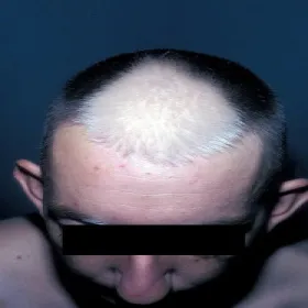 Bielactwo na głowie