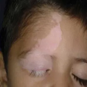 Bielactwo wrodzone u dziecka