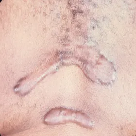 Blizna keloidowa wygląd