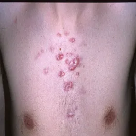 Bliznowiec na klatce piersiowej