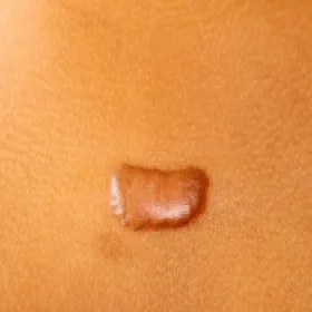 Bliznowiec na skórze