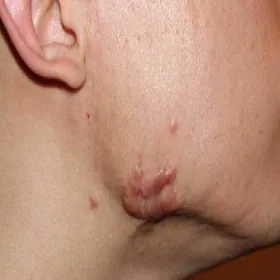 Bliznowiec na twarzy