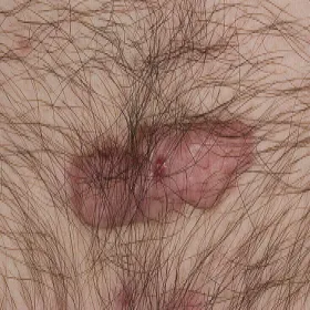 Bliznowiec w miejscu intymnym