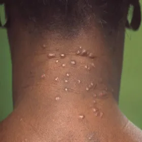 Blizny po trądziku na karku