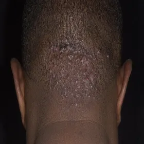 Bolące i swędzące blizny na głowie