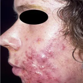 Bolesne torbiele trądzik skupiony 