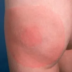 Borelioza zaczerwienienie skóry