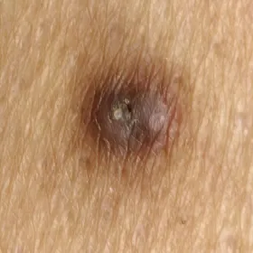 Brązowa grudka na skórze choroba Kyrle