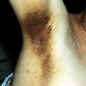 Brązowe plamy pod pachami