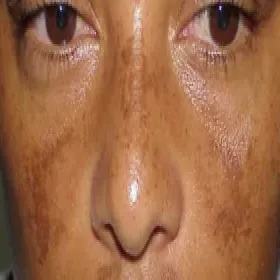 Brązowe przebarwienia na skórze choroba Addisona