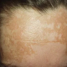 Brązowe przebarwienia na skórze