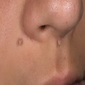 Brodawka nitkowata pod nosem