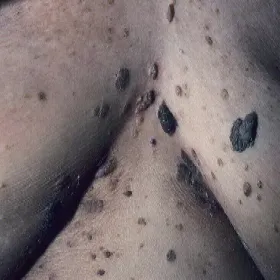 Brodawki łojotokowe między piersiami