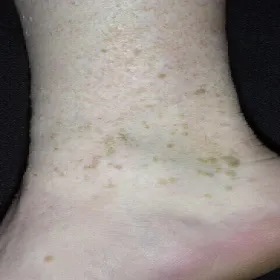 Brodawki łojotokowe na nodze