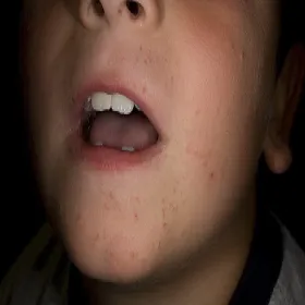 Brodawki na twarzy u dziecka