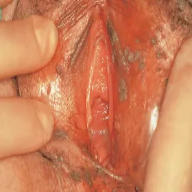 Brodawki płciowe u kobiet