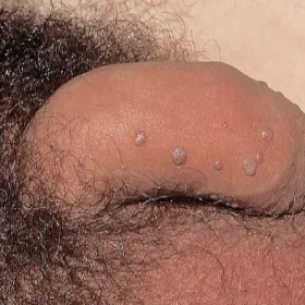 Brodawki płciowe u mężczyzn