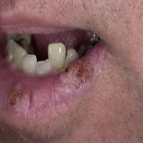 Brodawki u osób z obniżoną odpornością