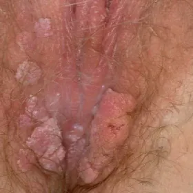 Brodawki weneryczne u kobiet