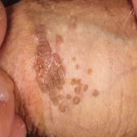 Brodawki weneryczne u mężczyzn