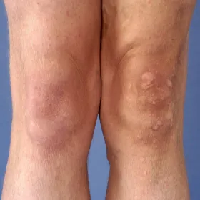 Brodawki zwykłe na nogach