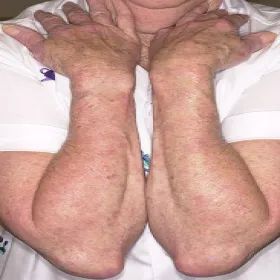CREST syndrome