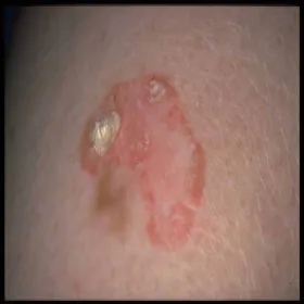 Carcinoma basocellulare exulceratum