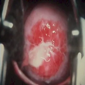 Chlamydia szyjki macicy