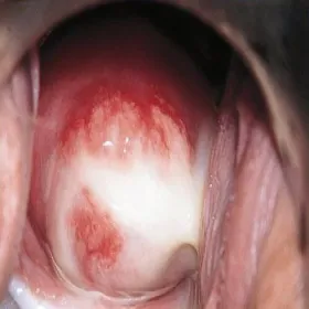 Chlamydia wydzieliny ropne z pochwy