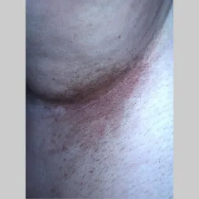 Choroba łupież rumieniowy 