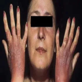 Choroba Addisona zdjęcia