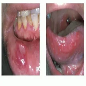 Choroba Behçeta jamy ustnej