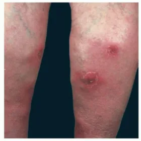 Choroba Behçeta objawy na nogach