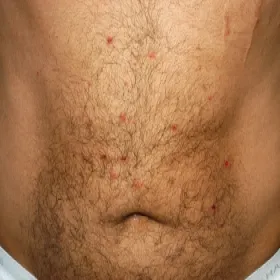 Choroba Behçeta objawy skórne