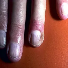 Choroba Bowena na paznokciu