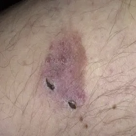 Choroba Bowena na skórze